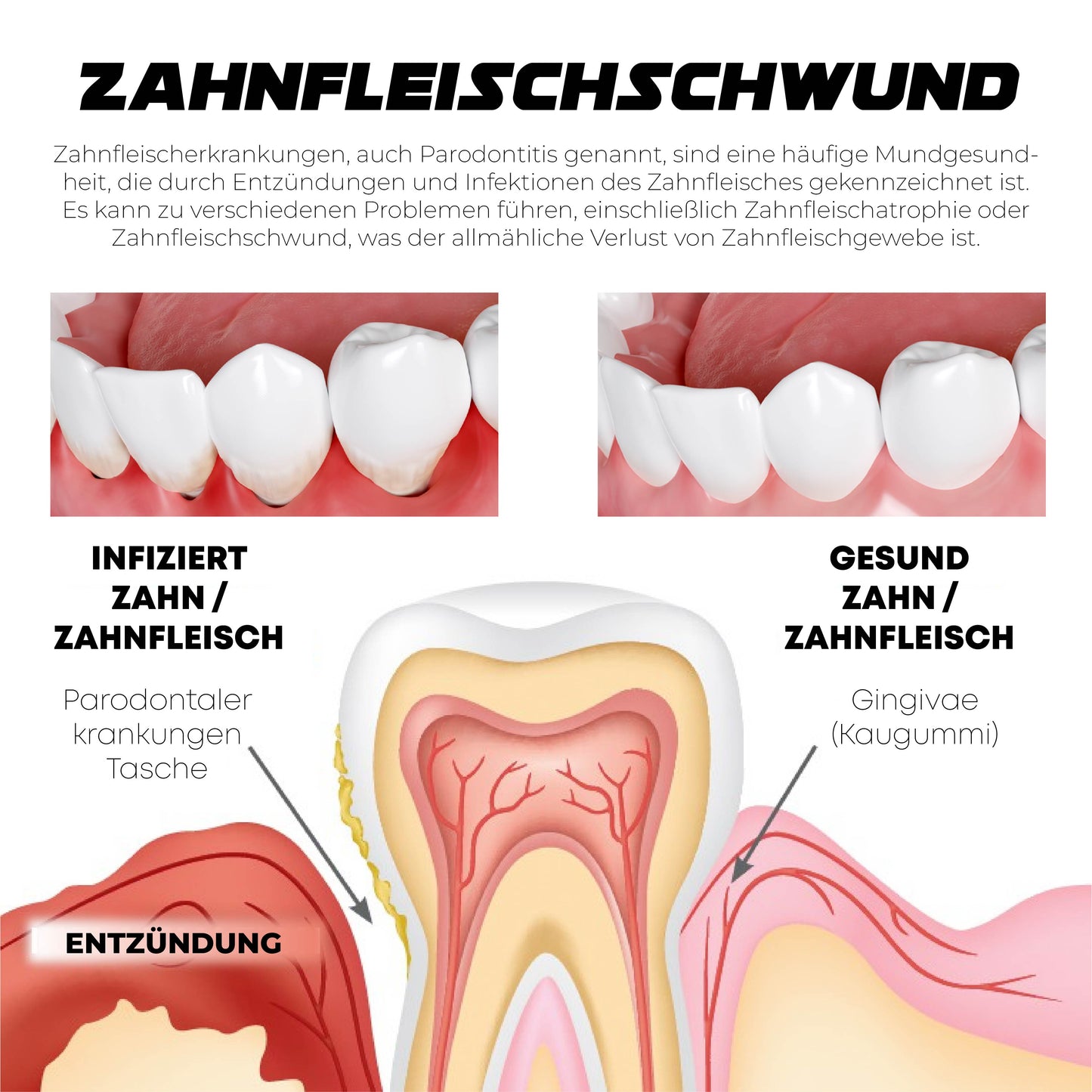 ATTDX Gummi Sofortig Behandlung Gel